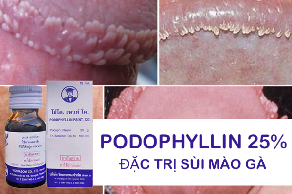 Podophyllin 25 Thái Lan điều trị sùi mào gà hiệu quả tại nhà Podophyllin 25 Thái Lan điều trị sùi mào gà hiệu quả tại nhà